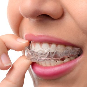 a patient wearing their Invisalign tray