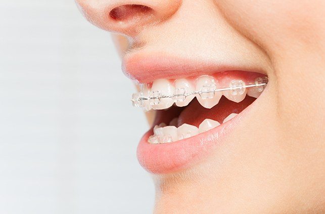 Closeup of smile with braces made from clear and ceramic materials