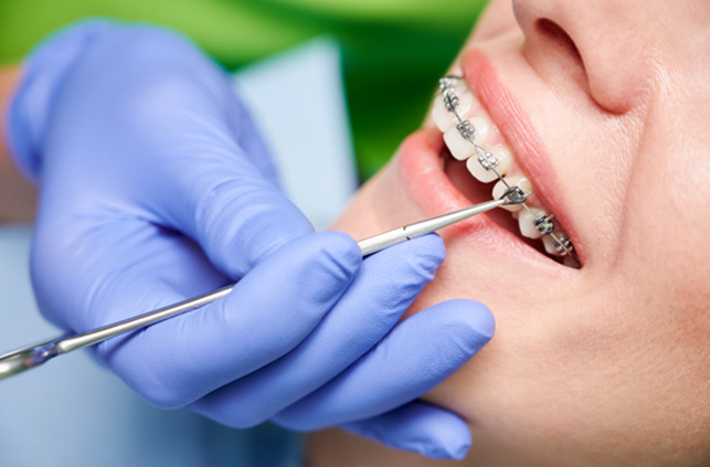 Close-up of patient’s mouth during orthodontic appointment