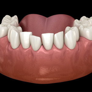 Illustration of crowded teeth