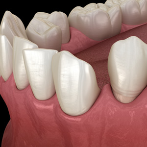 Illustration of gapped teeth