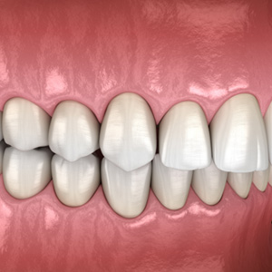 Illustration of an overbite
