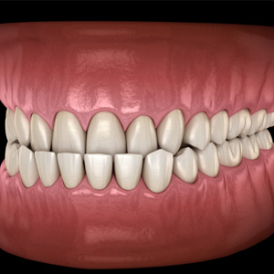 Illustration of an underbite