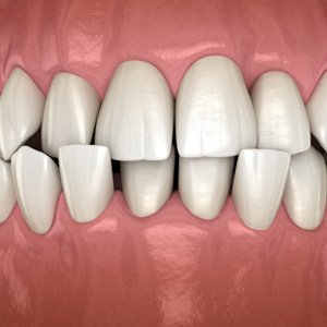 Illustration of a crossbite