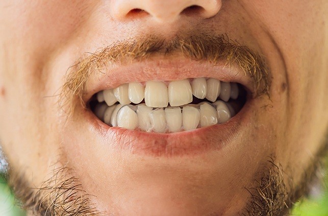 Closeup of smile with Invisalign tray in place