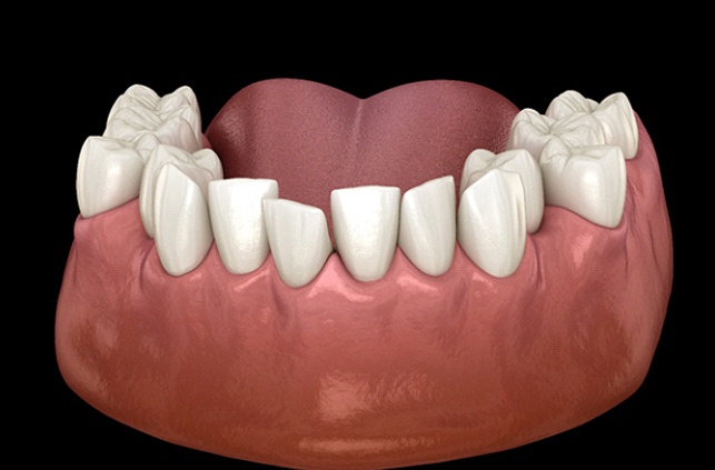 Diagram of overcrowded teeth in Lawrence before orthodontic treatment