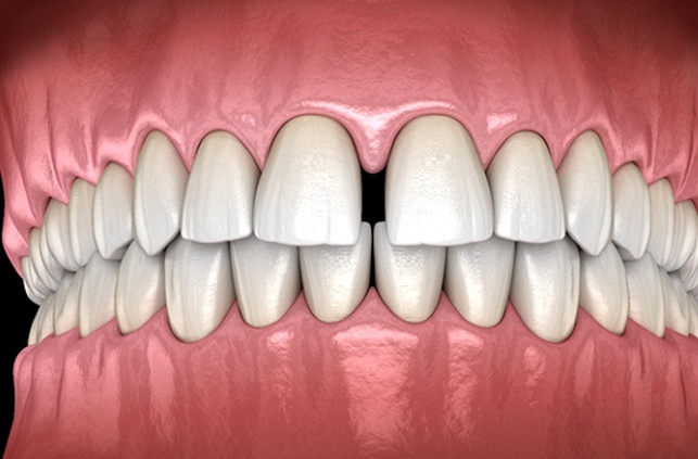 Diagram of gap between teeth in Lawrence before orthodontic treatment