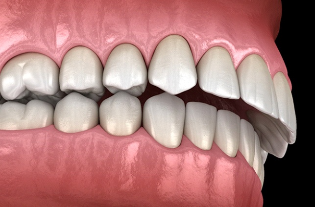 Diagram showing overbite in Lawrence before orthodontic treatment