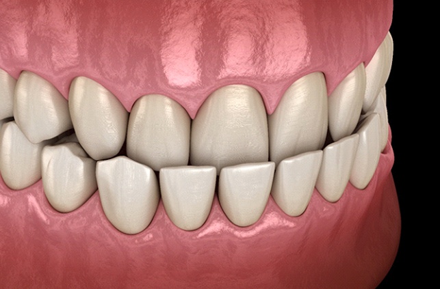 Diagram showing an underbite in Lawrence before orthodontic treatment