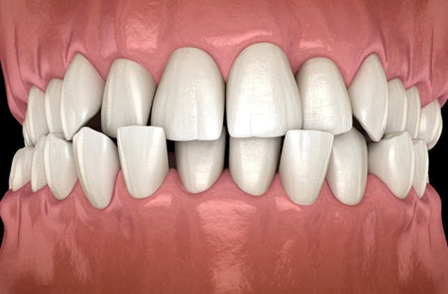 Diagram showing crossbite in Lawrence before orthodontic treatment