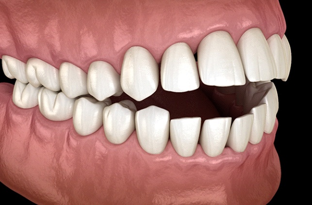 Diagram showing open bite in Lawrence before orthodontic treatment