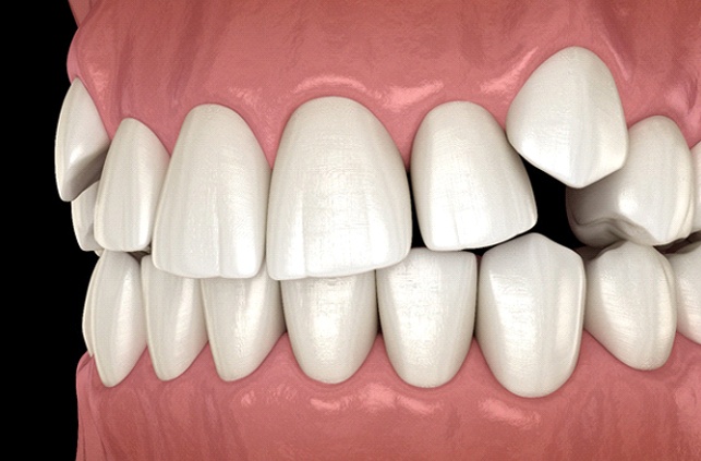 Diagram of impacted canines in Lawrence before orthodontic treatment