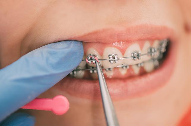 Orthodontist placing traditional metal braces