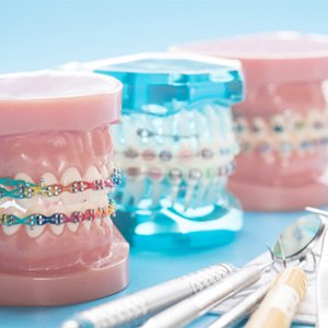 a closeup of models of teeth with braces