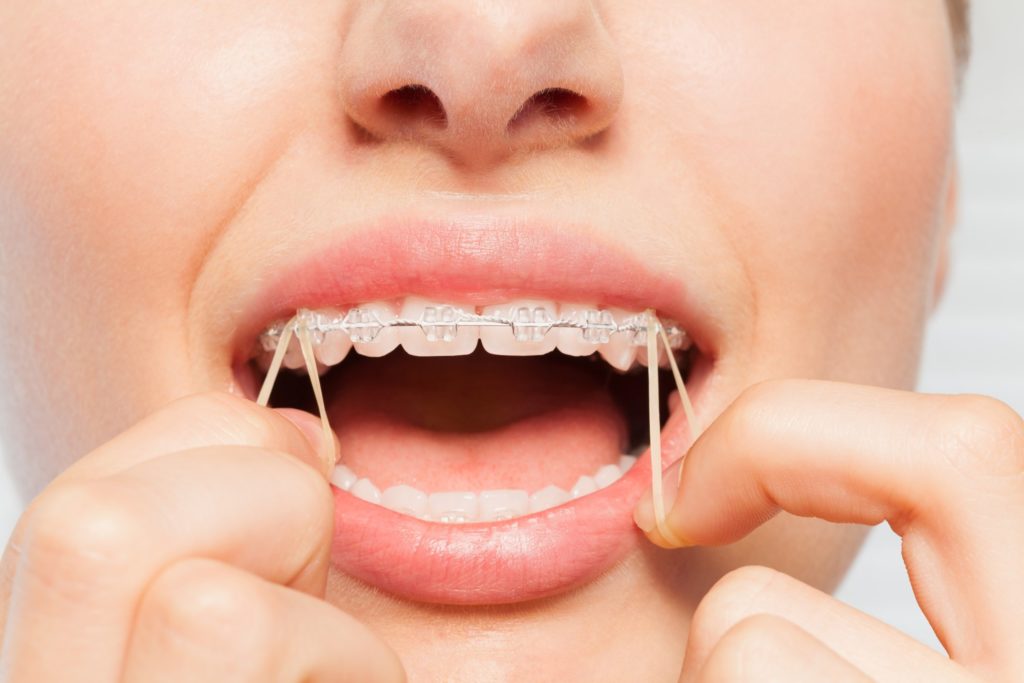 Woman placing rubber bands on her dental braces