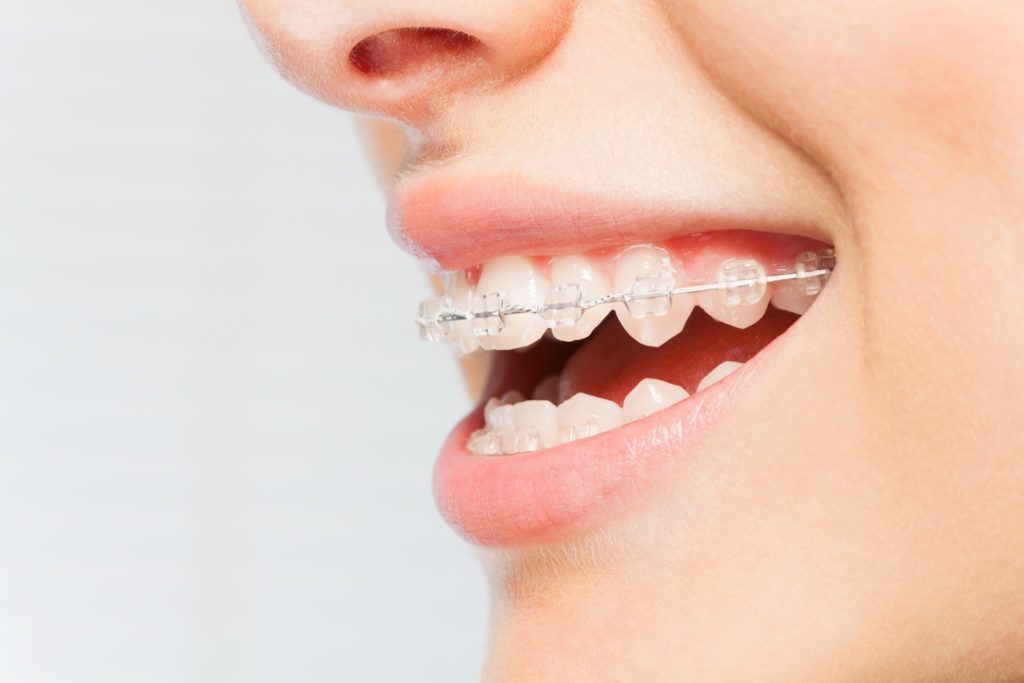 Closeup of woman smiling with braces