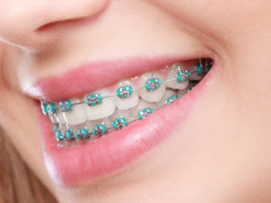 Closeup of patient wearing traditional braces in Lawrence