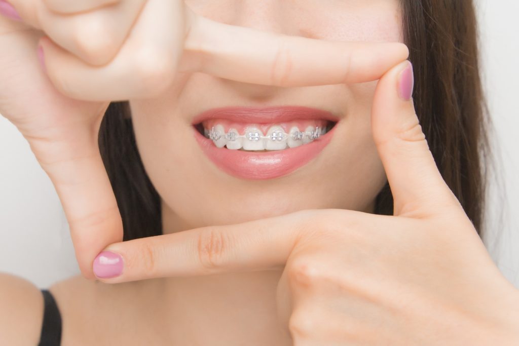 Woman using her fingers to frame her self-ligating braces