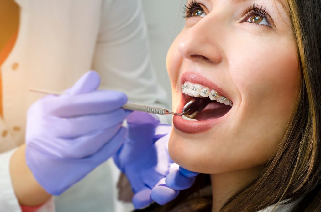 Closeup of woman with braces on top teeth