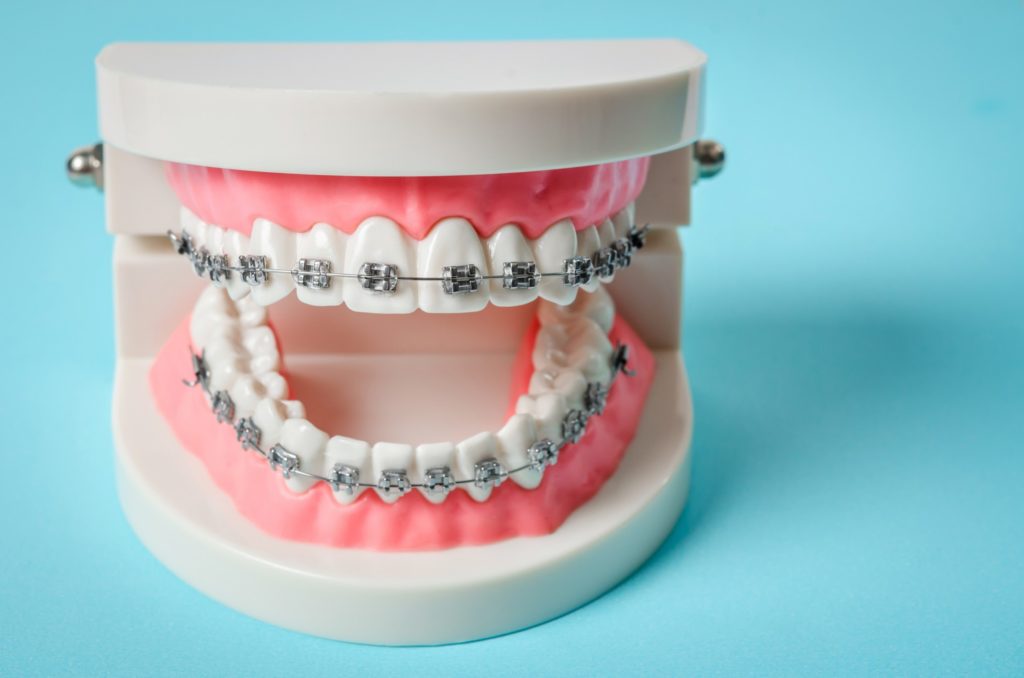 Closeup of traditional braces on model of teeth