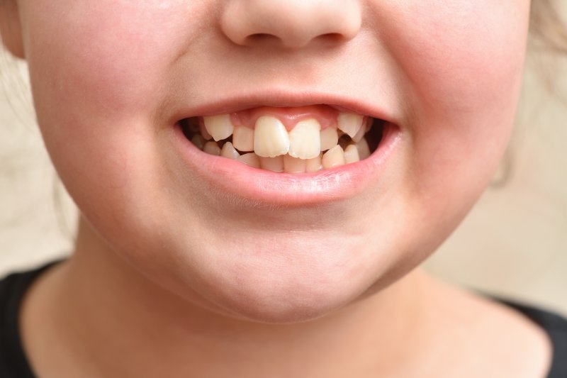 child with crooked teeth